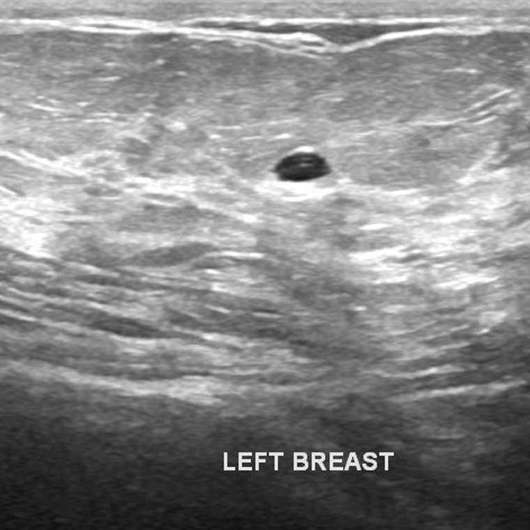 Breast screening image to classify
