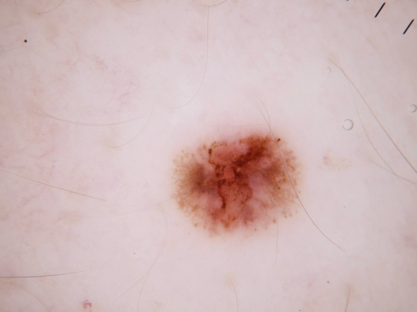 AEGIS P23 SkinScan — dermoscopy image grid showing 7 skin disease classes