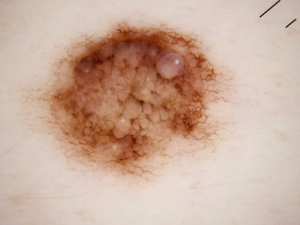 AEGIS P23 SkinScan — dermoscopy AI skin disease triage classifier