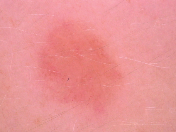AEGIS P23 SkinScan — seven skin disease classes dermoscopy examples